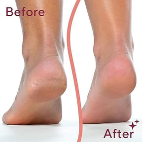 Electric Feet Callus Remover